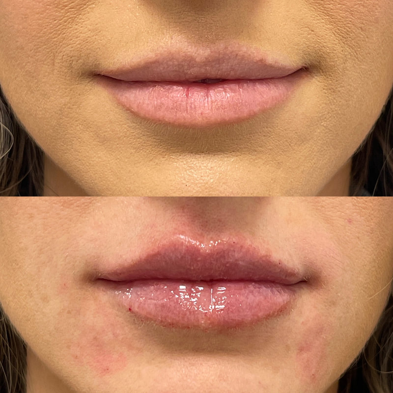 Lip Injection - Before & After 9