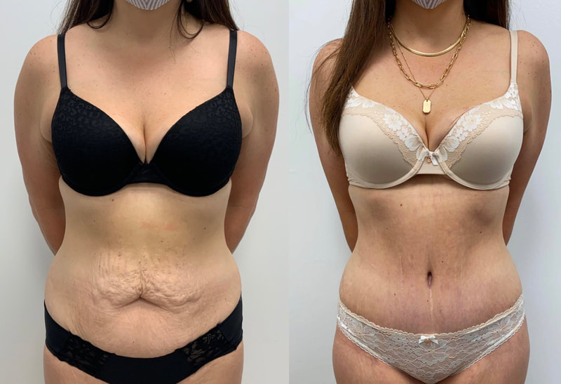 tummy tuck  - before & after 129
