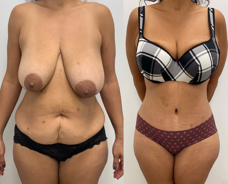 tummy tuck  - before & after 142