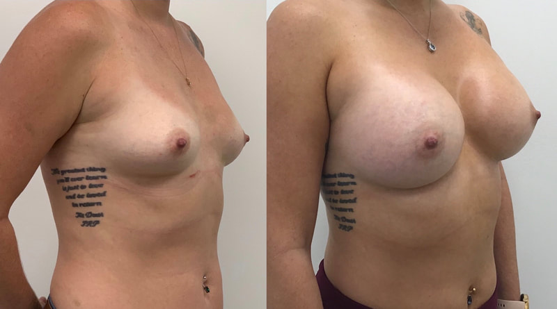 Breast implant before & after 110