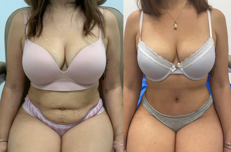 tummy tuck  - before & after 148