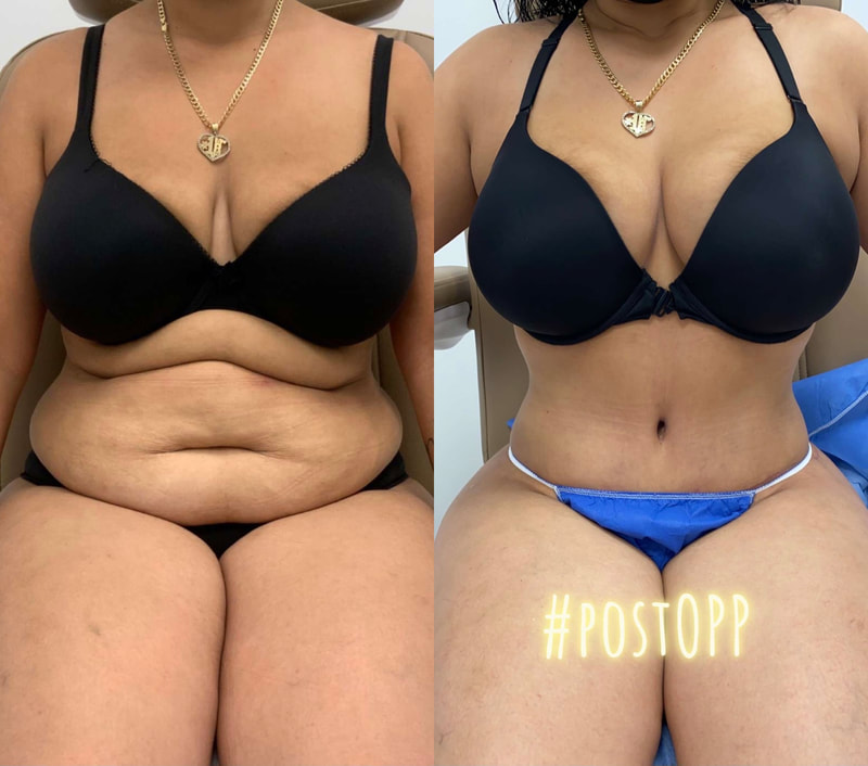tummy tuck  - before & after 123