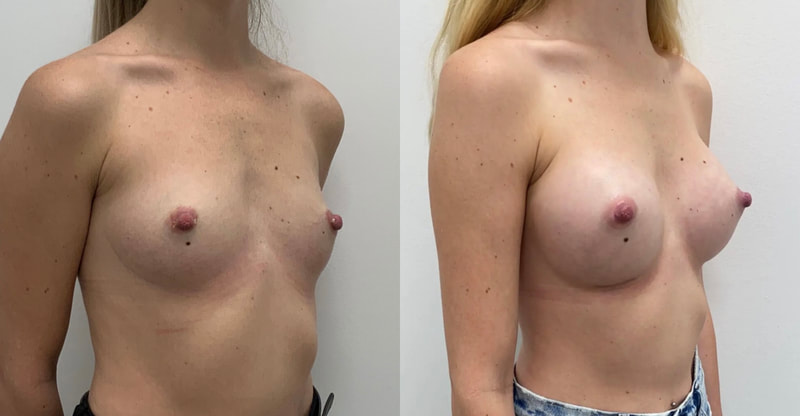 Breast implant before & after 128