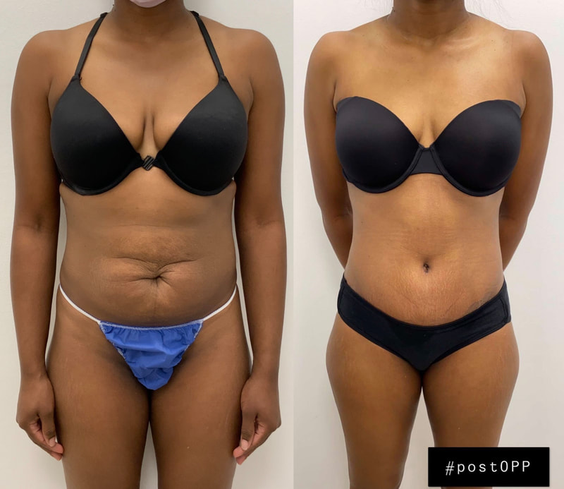 tummy tuck  - before & after 109