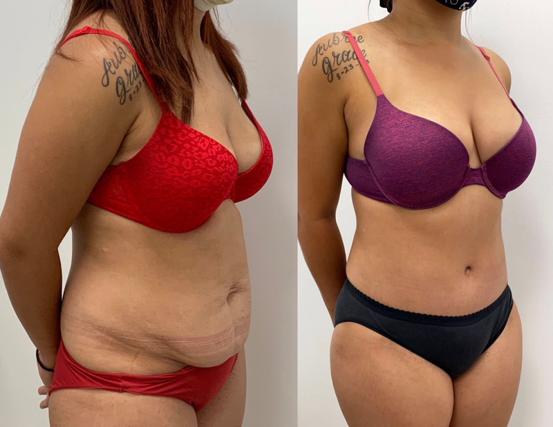tummy tuck  - before & after 102