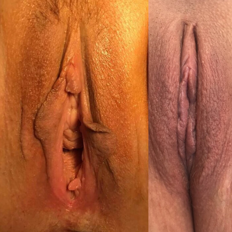 Labiaplasty - Before & After Sample Photo