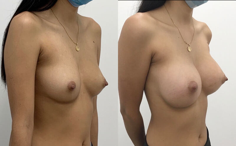 Breast implant before & after 108