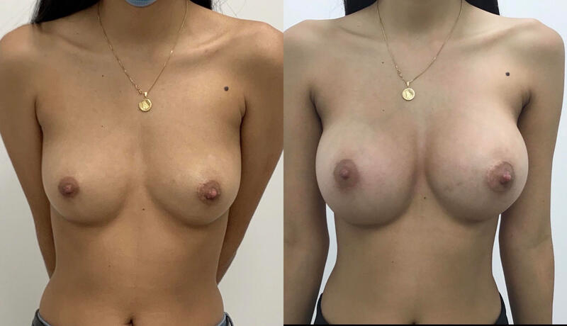 Breast implant before & after 109