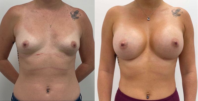Breast implant before & after 111