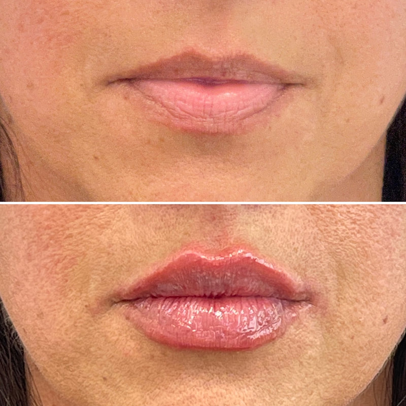Lip Injection - Before & After 14