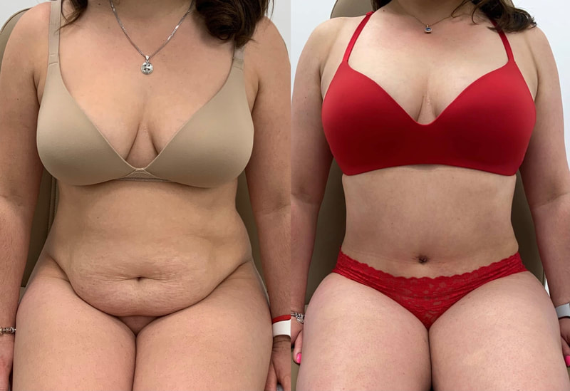 tummy tuck  - before & after 139