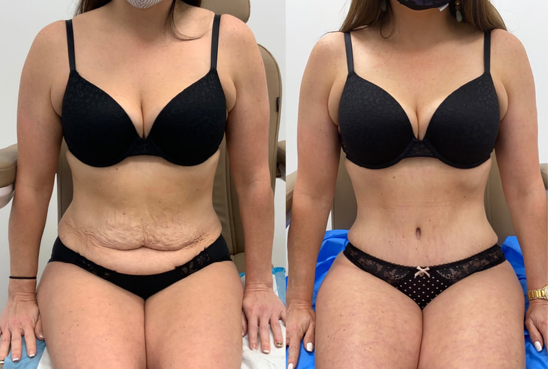 tummy tuck  - before & after 143