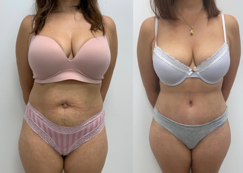 tummy tuck  - before & after 149