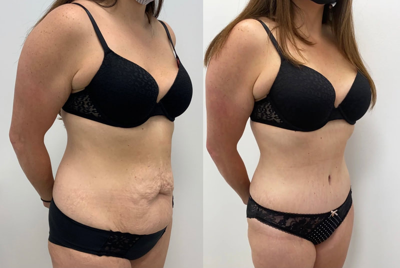 tummy tuck  - before & after 144
