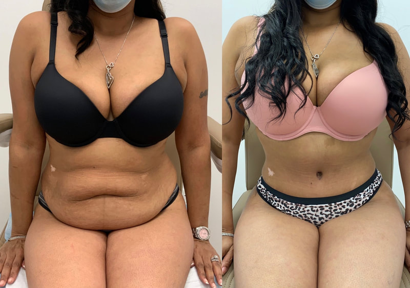 tummy tuck  - before & after 130