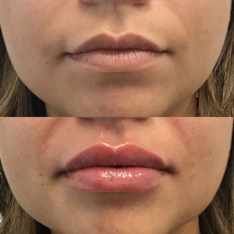 Lip Injection - Before & After 13