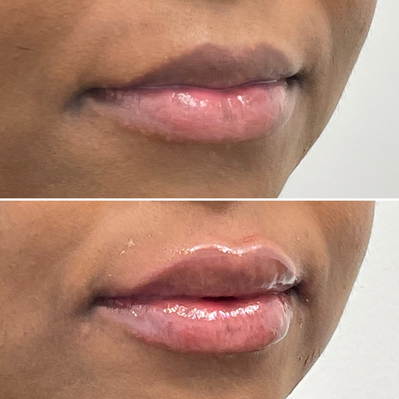 Lip Injection - Before & After 18