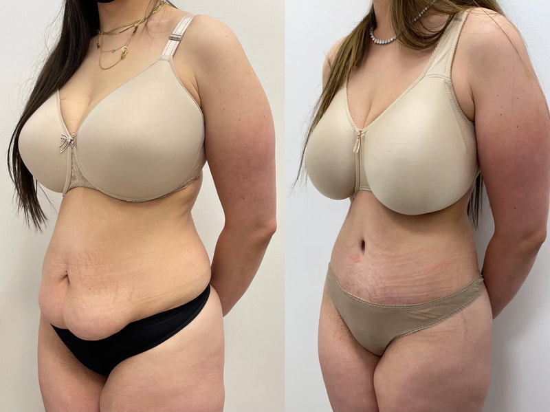 tummy tuck  - before & after 151