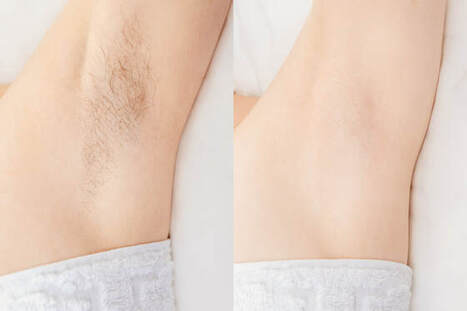 Laser Hair Removal After A Series Of Treatments