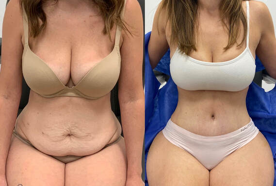 Before and after Tummy Tuck