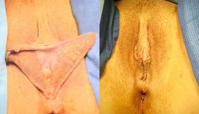 wedge labiaplasty before and after
