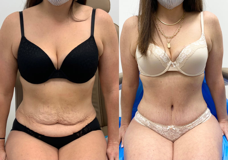 tummy tuck  - before & after 128