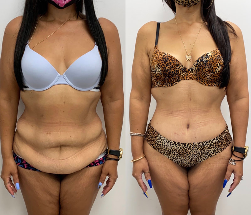 tummy tuck  - before & after 119
