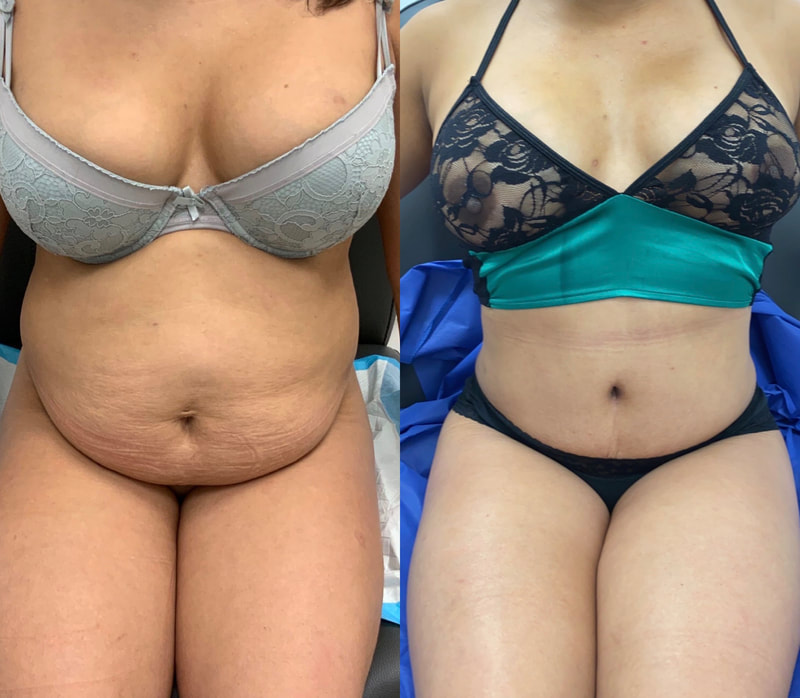 tummy tuck  - before & after 106