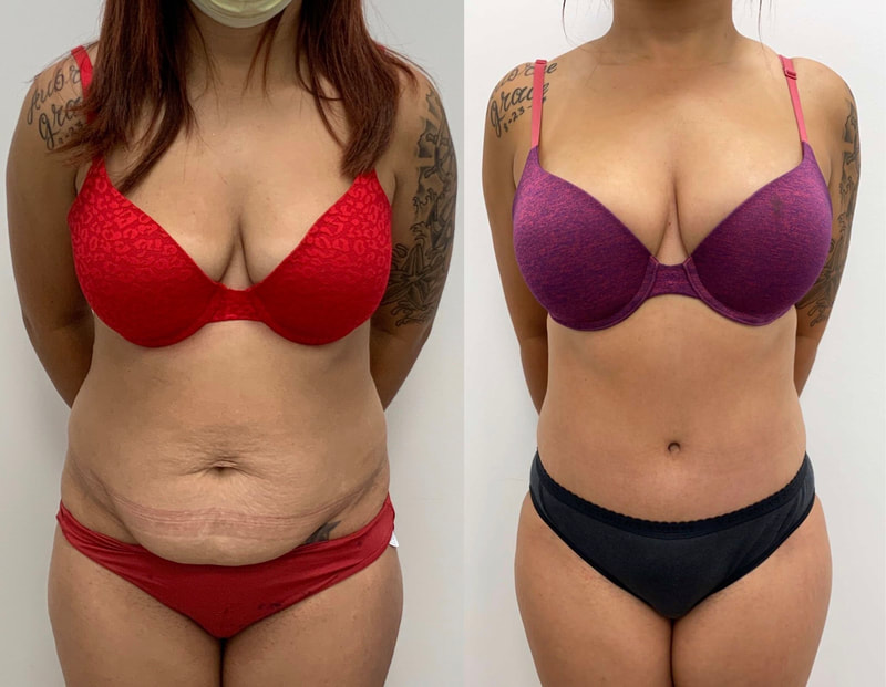 tummy tuck  - before & after 104