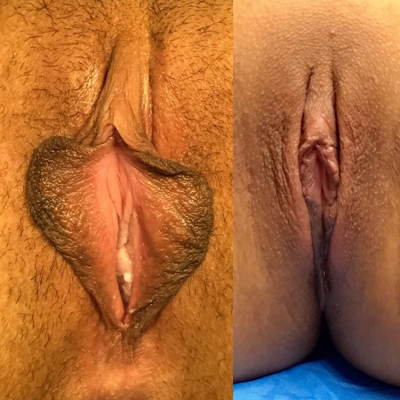 Dark inner labia before and after labiaplasty 