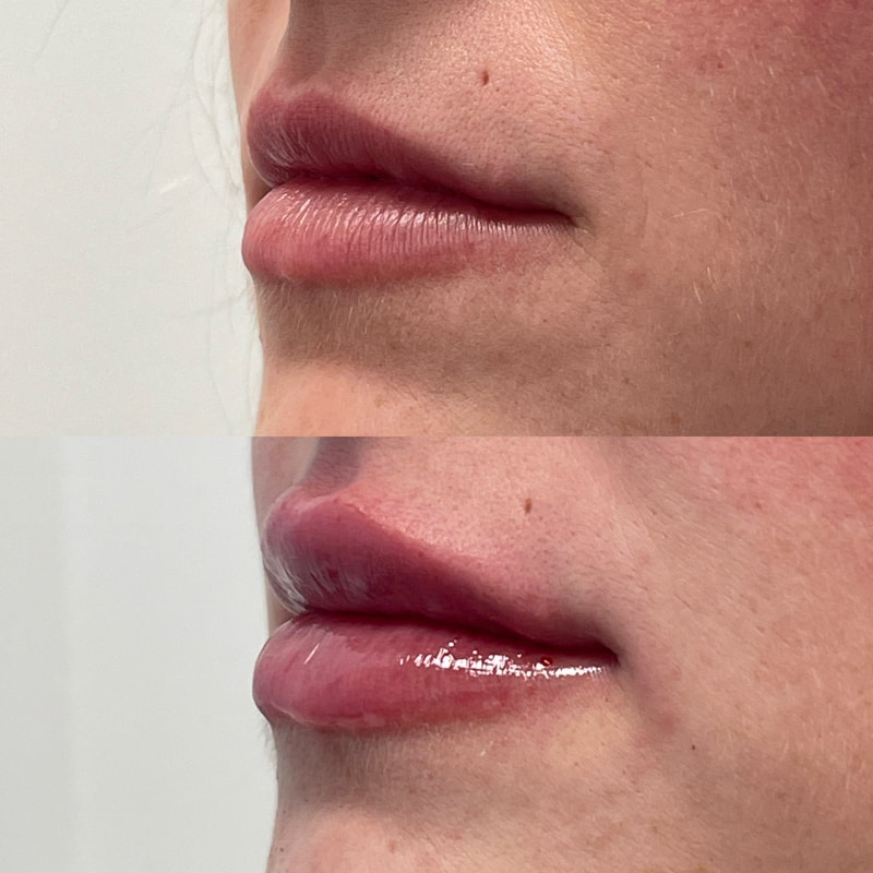 Lip Injection - Before & After 11