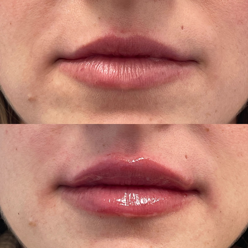 Lip Injection - Before & After 10