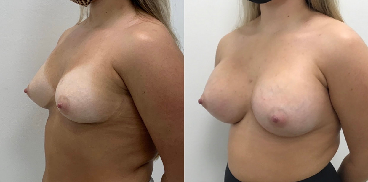 Breast implant before & after 114