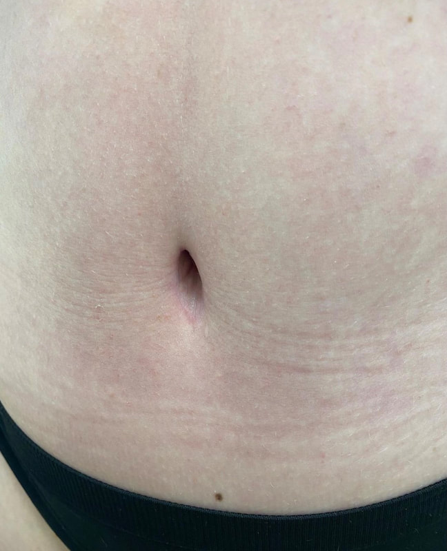Post Opp - Belly Button Sample Image