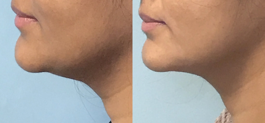 Facial Lipo Before & After 1
