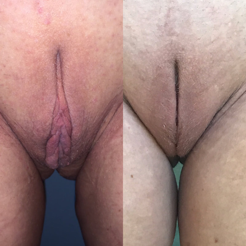 Labiaplasty - Before & After Sample Photo