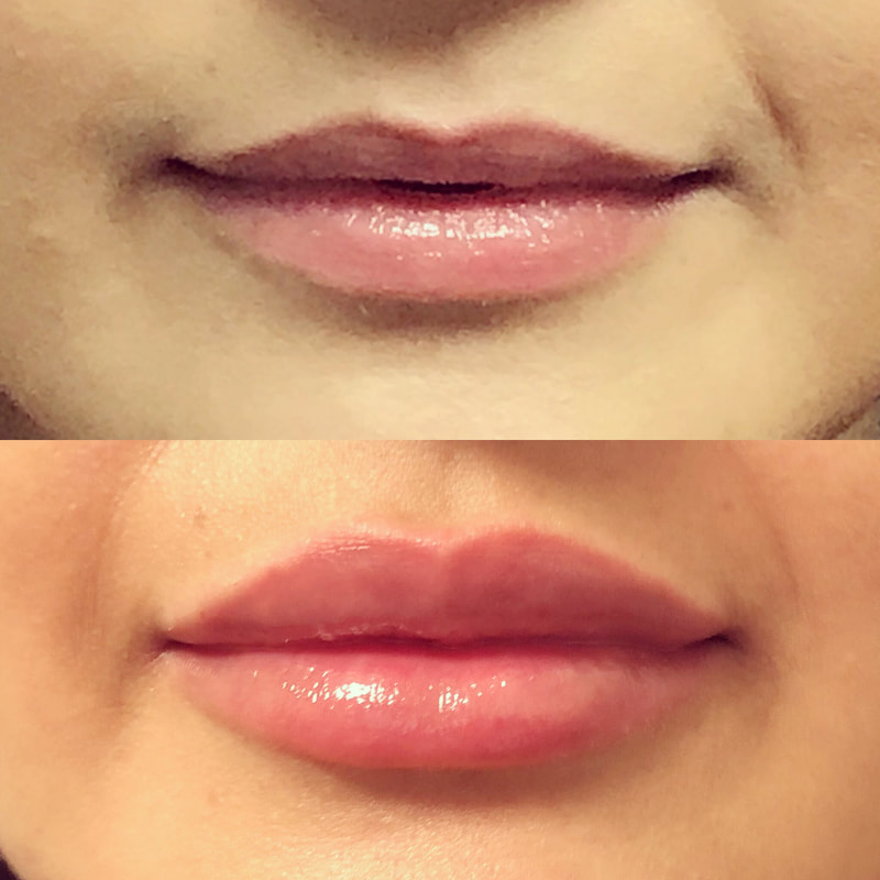 Lip Injection - Before & After 3