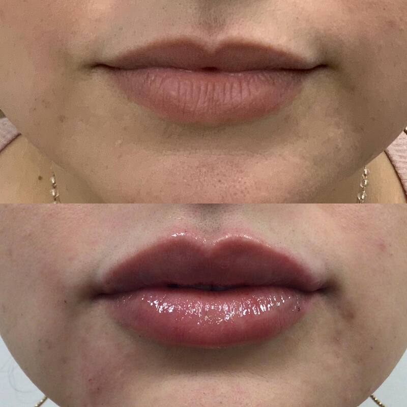 Lip Injection - Before & After 12