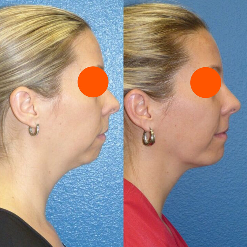 Facial Lipo Before & After 4