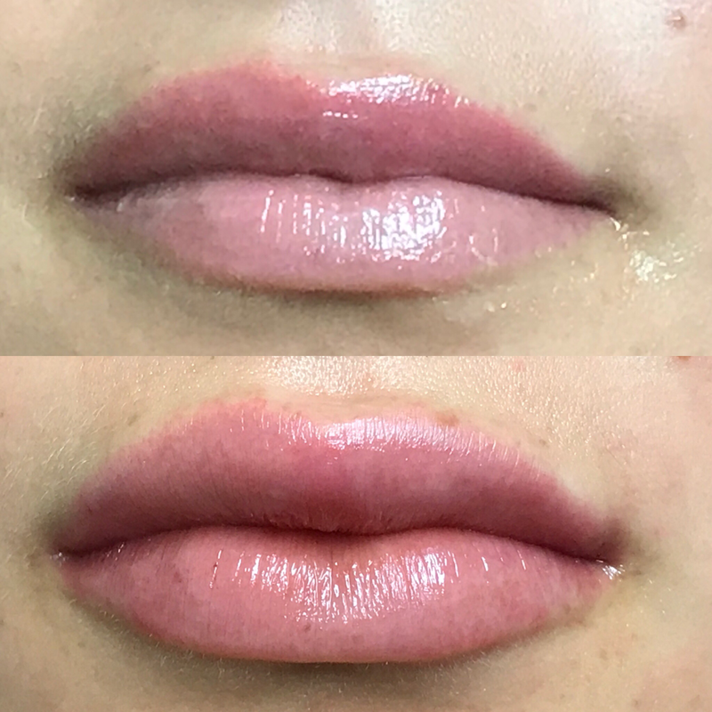 Lip Injection - Before & After 5