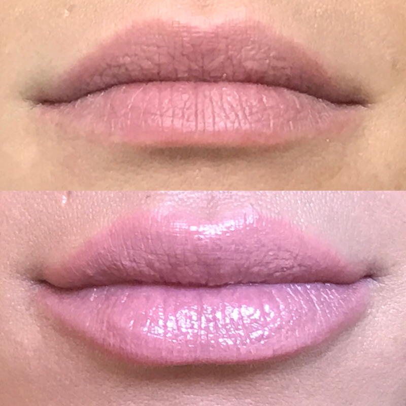 Lip Injection - Before & After 6