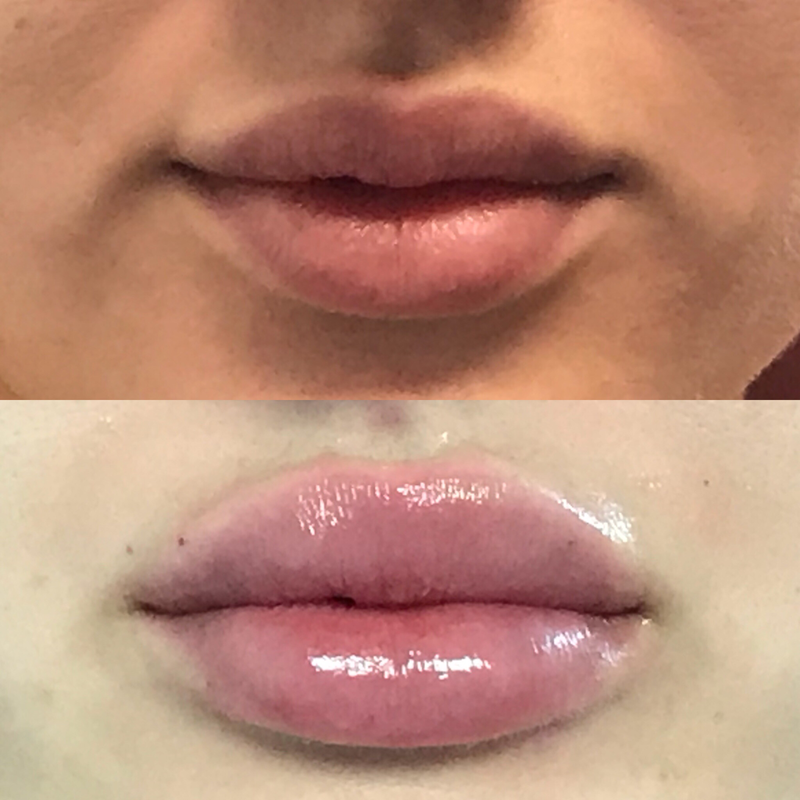 Lip Injection - Before & After 7