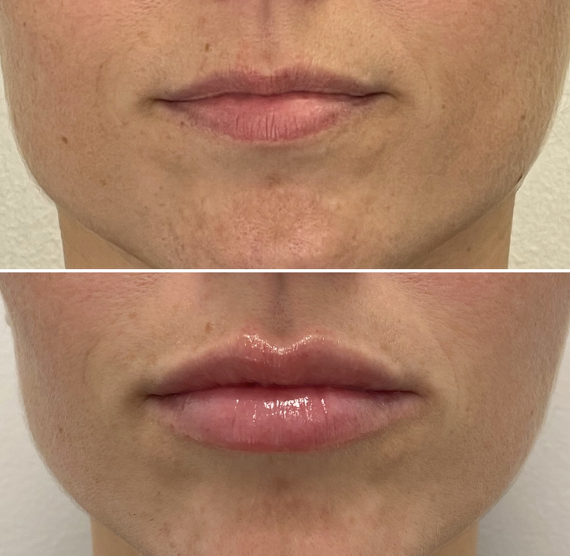 Lip Injection - Before & After 20