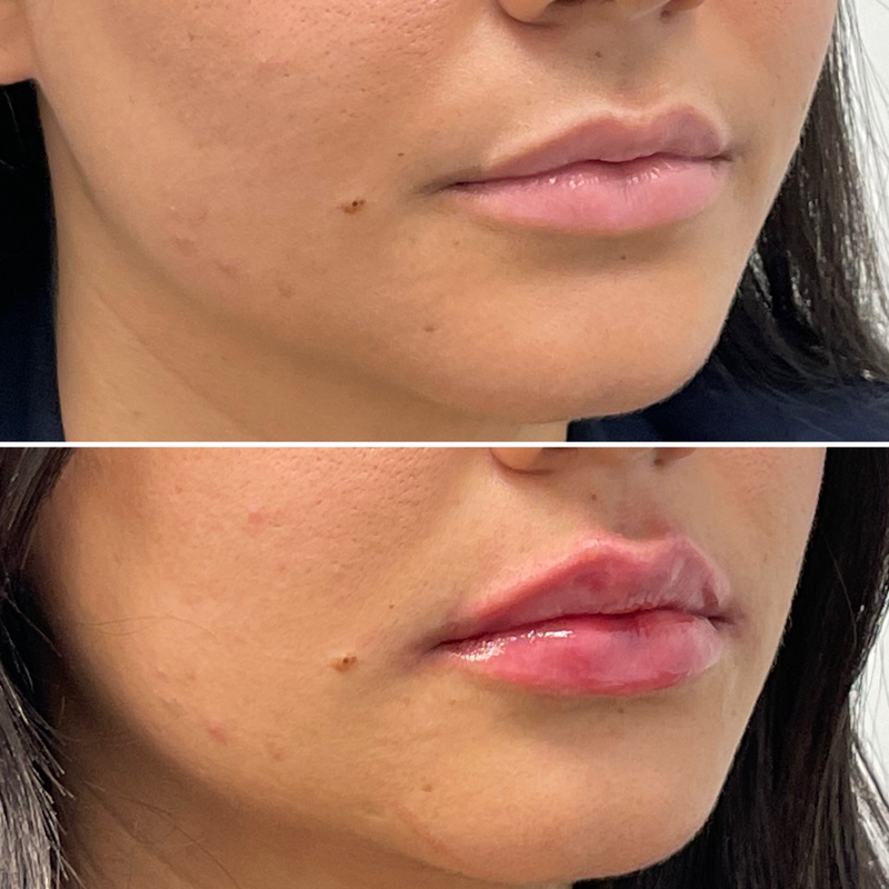 Lip Injection - Before & After 23