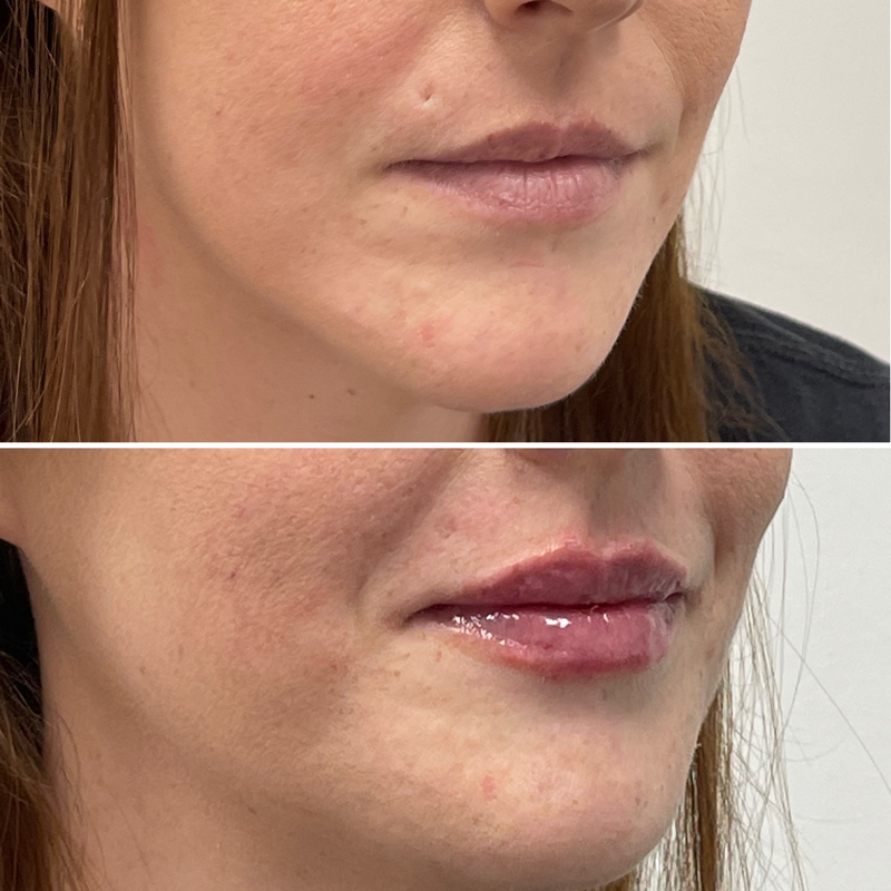 Lip Injection - Before & After 25