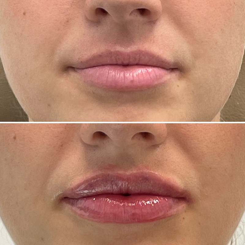 Lip Injection - Before & After 26
