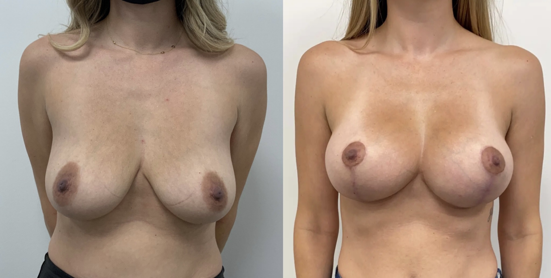 Breast implant before & after 135