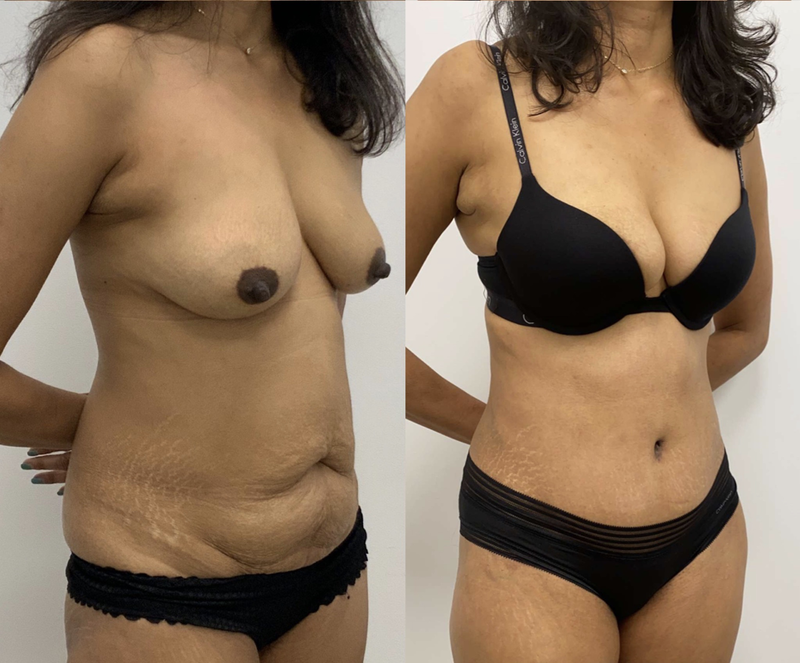 tummy tuck  - before & after 113
