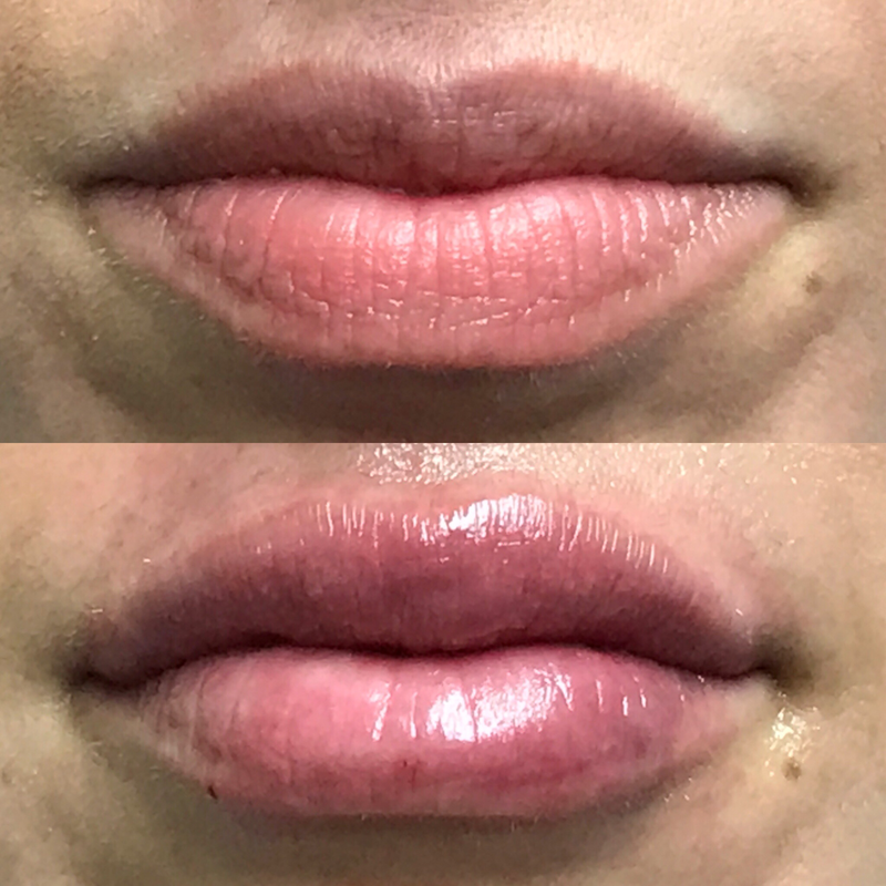 Lip Injection - Before & After 4