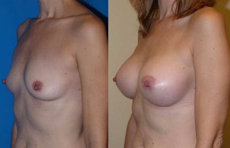 Breast implant before & after 7
